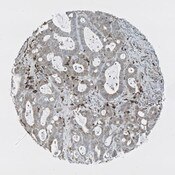 IHC of tissue microarray core of colon cancer stained with DSHB antibody CPTC-CD74-1 against CD74 (brown). Image credit: Clinical Proteomics Technologies for Cancer